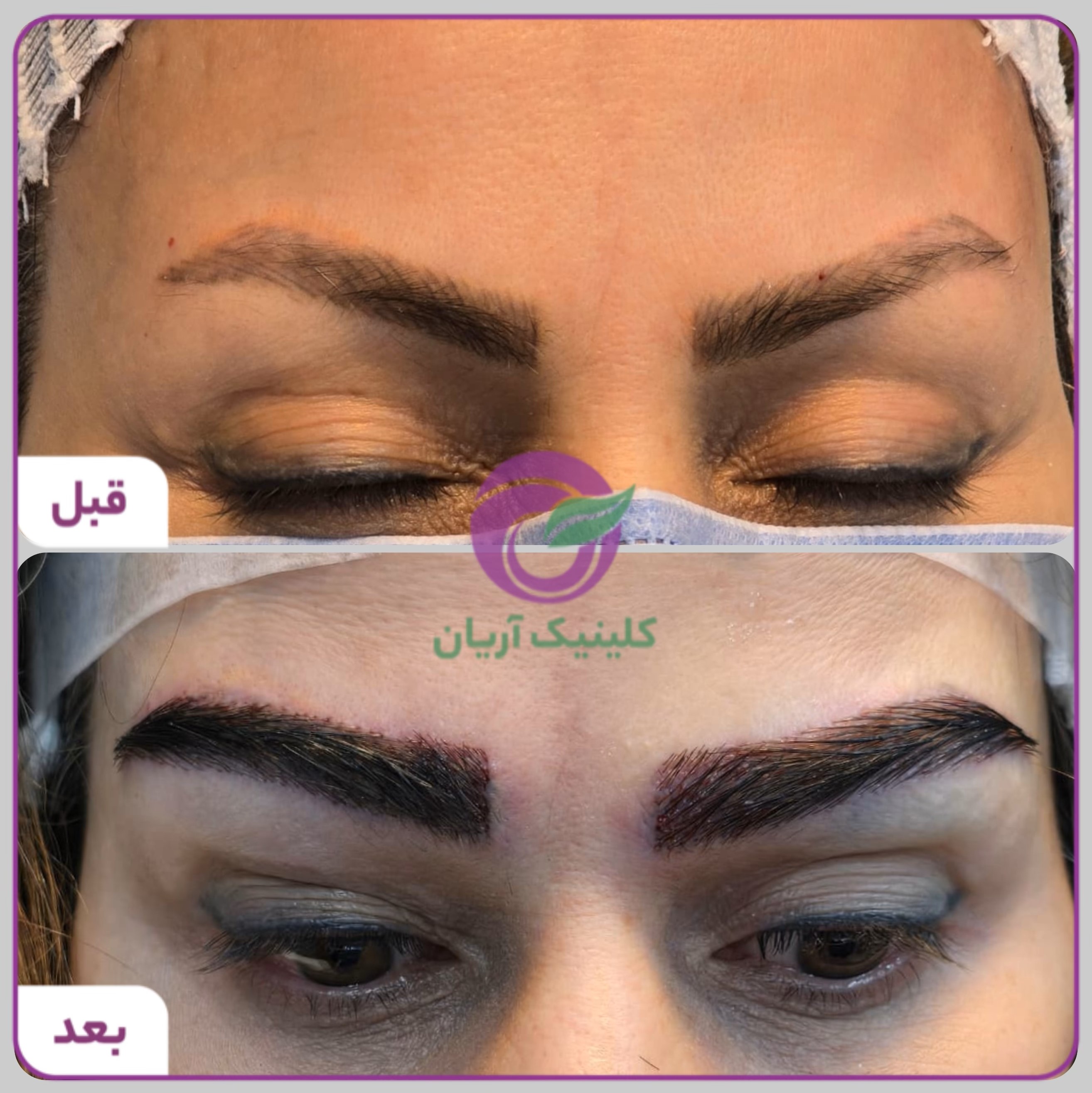 گالری فیلم کاشت ابرو